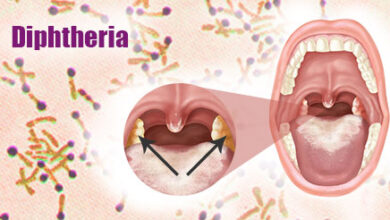 diphtheria